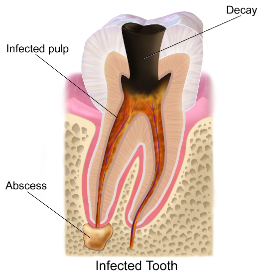 tooth decay