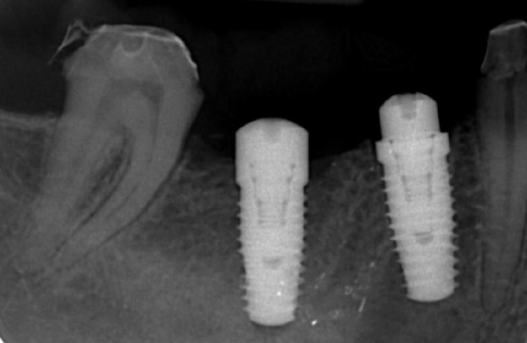type-of-dental-implants