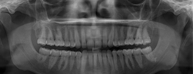 x-ray-teeth