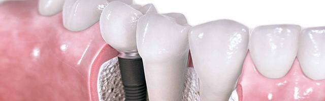 How Are Instant Implants Different From Regular Implants?