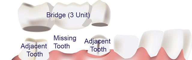 The Most Common Problems With Dental Bridge