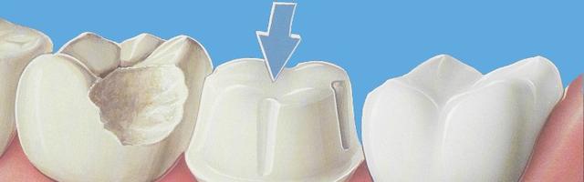Metal Free Dental Crowns