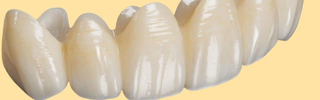 Should I get bridge or a dental implant?
