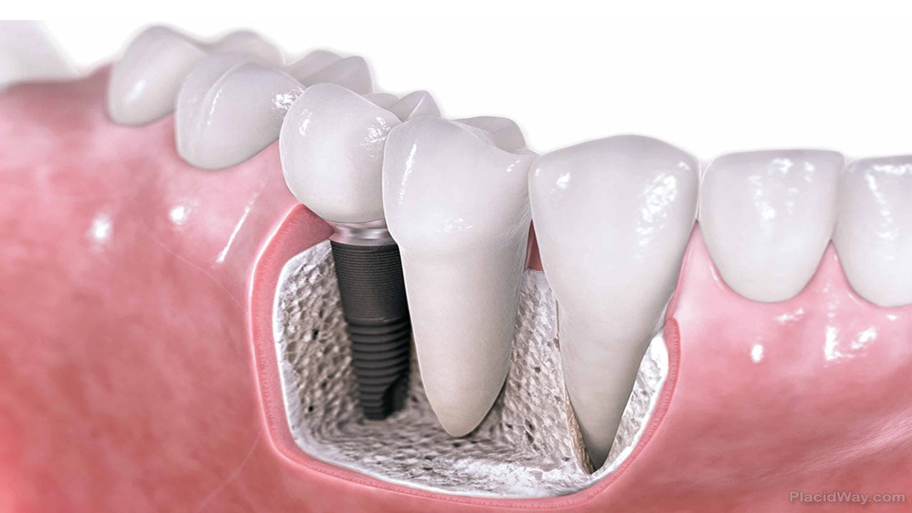 dental implant take does treatment tooth london