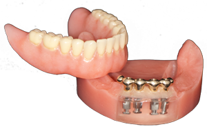 dentures tipe