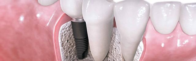 How long does it take to complete the dental implant treatment?