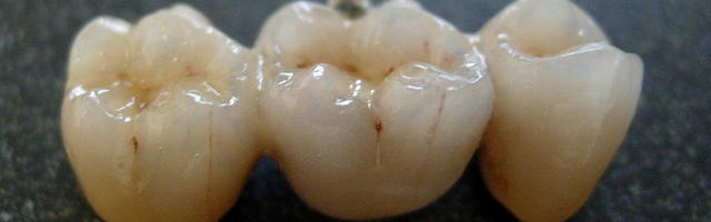 What is a Dental Bridge?