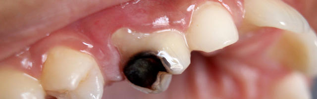 Black Teeth