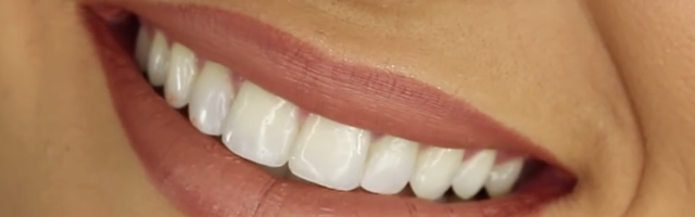 Dental Implant FAQ 3.