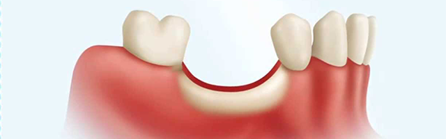 Bone Grafting For Dental Implants