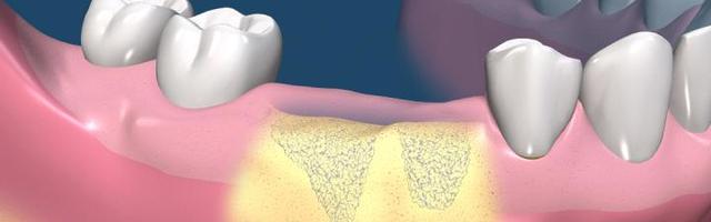 Bone Regeneration and Dental Implants