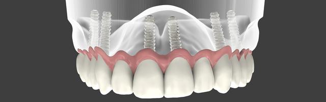Denture Retention Implants