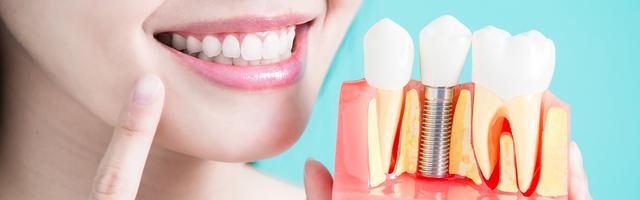 Instant Dental Implants
