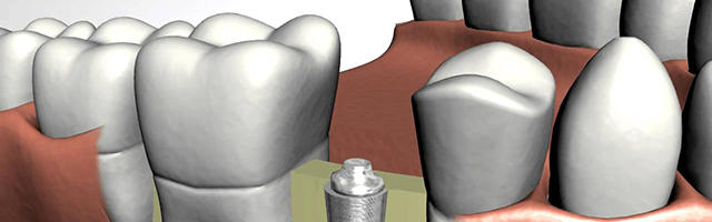 Why are dental implants so costly?