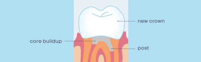 What is a Post and Core Tooth Replacement Method?