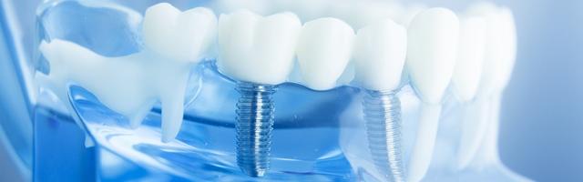 How long does a dental implant last, and what sort of guarantee do these dental implants come with?