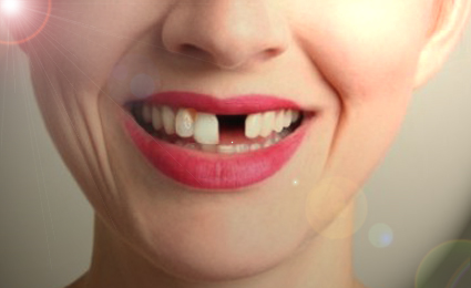 A single tooth gap can lead to more tooth loss!