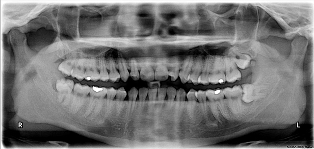 impacted-wisdom-teeth