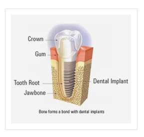 Bone replacement