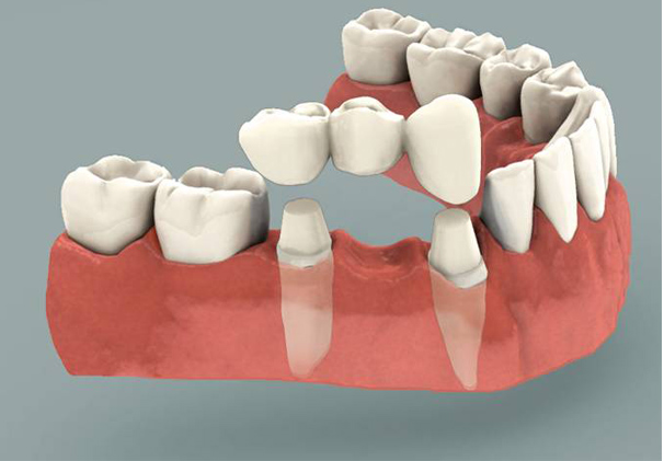 Dental Bridge Process