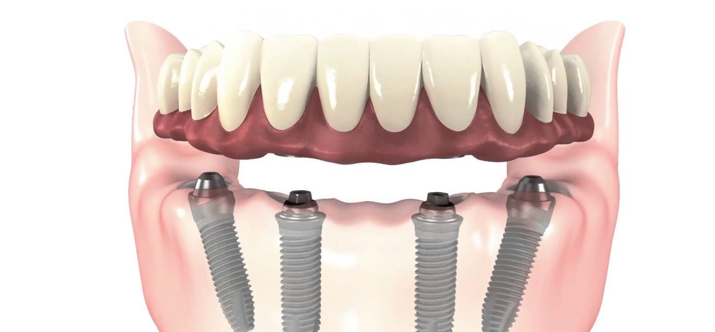 dental implant