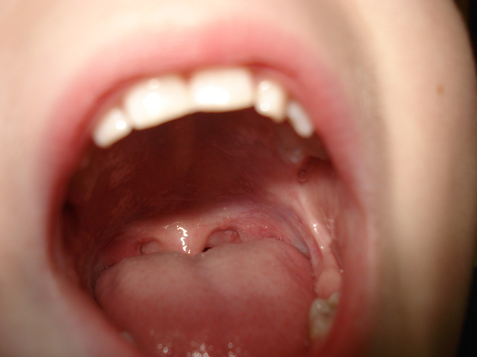 Periodontitis